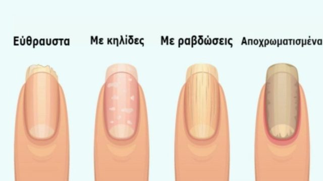 7 + 1 σημάδια στα νύχια που προειδοποιούν για σοβαρά προβλήματα υγείας