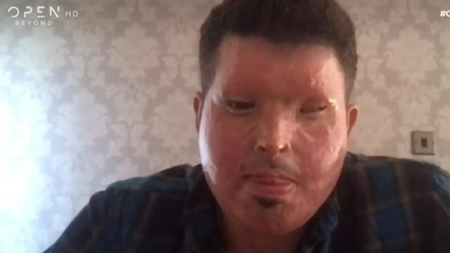 Συγκλονίζει ο Ανδρέας Χριστοφέρος: Mιλά για την επίθεση με οξύ που δέχτηκε και στέλνει μήνυμα στην Ιωάννα Παλιοσπύρου