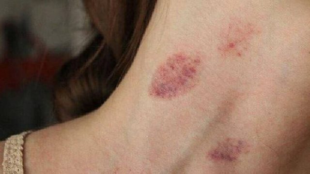 «Δαγκώματα αγάπης»: Πόσο επικίνδυνες μπορεί να είναι οι πιπιλιές;