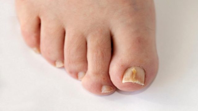 Δώστε προσοχή! Αυτό το σημάδι στα νύχια δείχνει αν κινδυνεύετε από καρκίνο