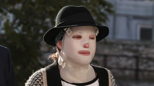 Επίθεση με βιτριόλι: «Η Ιωάννα σκεφτόταν μόνο τον προσωπικό της θάνατο» – Η συγκλονιστική περιγραφή του ψυχιάτρου της