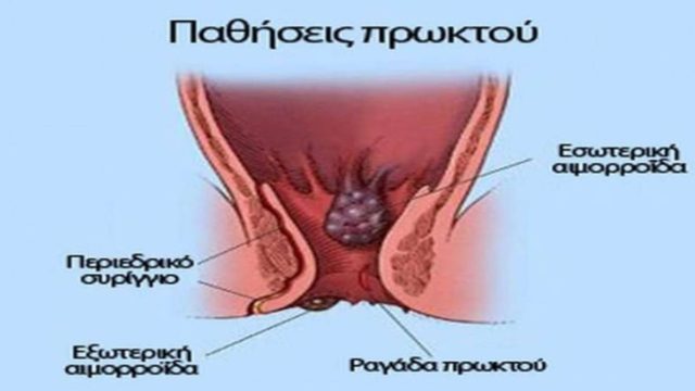 Καρκίνος πρωκτού: Αν έχετε αυτά τα συμπτώματα τρέξτε αμέσως στον γιατρό!