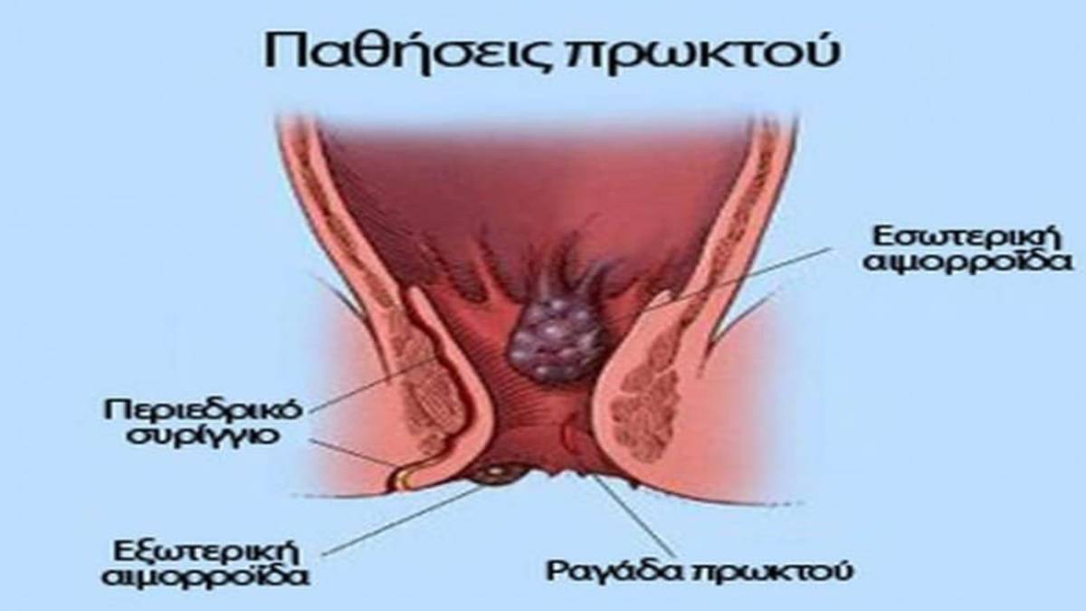 Καρκίνος πρωκτού: Αν έχετε αυτά τα συμπτώματα τρέξτε αμέσως στον γιατρό!