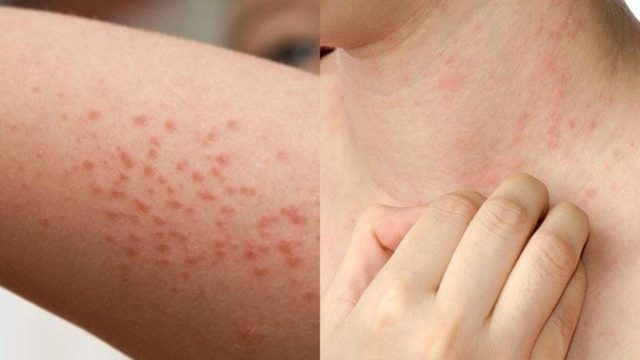 Υπέφερε από κοκκινίλες και φαγούρες – Μόλις δοκίμασε λίγη μαγειρική σόδα…
