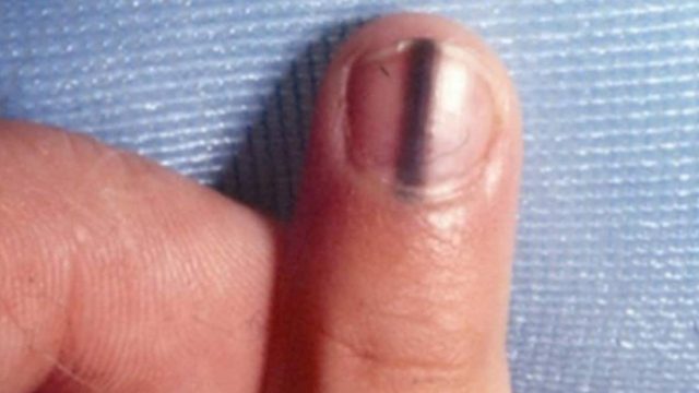 Παρατήρησε μια μαύρη γραμμή μέσα στο νύχι της – Τότε ο γιατρός της αποκάλυψε ότι… (Video)