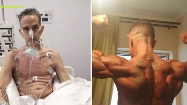 Απίστευτο: Δεν εμβολιάστηκε, «κόλλησε» κορωνοϊό κι έχασε 42 κιλά!