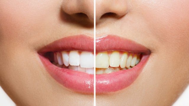 Λευκά δόντια; 5+1 πανεύκολα tips για περισσότερη λάμψη