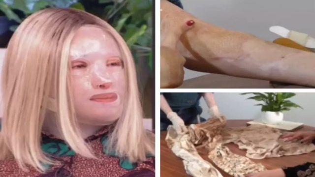 Δυστυχώς: Άσχημα τα νέα για την Ιωάννα Παλιοσπύρου – Τι της είπαν οι γιατροί στο Παρίσι για τα εγκαύματα;
