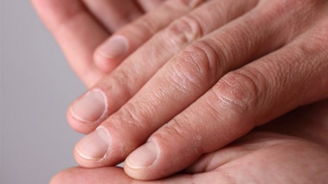 Μεγάλη προσοχή: Τα νύχια των ποδιών σας δείχνουν αν κινδυνεύετε από καρκίνο