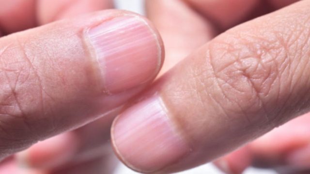 Αν δείτε αυτό στα νύχια σας, πρέπει να ελέγξετε τον θυρεοειδή σας