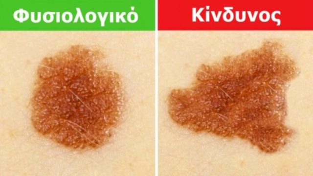 Μεγάλη προσοχή! Δείτε πως θα καταλάβετε αν κάποιο σημάδι στο σώμα σας είναι επικίνδυνο για ανάπτυξη καρκίνου (photos)