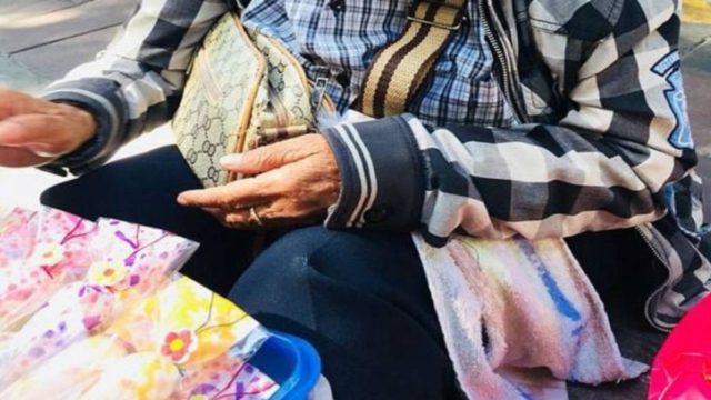 Αυτή η 63χρονη γιαγιά έχει την πιο σπάνια πάθηση – Μόλις δείτε το πρόσωπό της θα ανατριχιάσετε