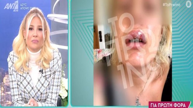 Σοκάρει η 38χρονη που καταγγέλει ότι παραμορφώθηκε από γνωστό πλαστικό χειρουργό: «Έχω κάνει δύο απόπειρες αυτοκτονίας» (Video)