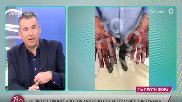 Σοκαριστικές εικόνες – Τζώρτζης Μονογυιός: Τα εγκαύματα του φίλου του που τον απεγκλώβισε από τη Ferrari (video)