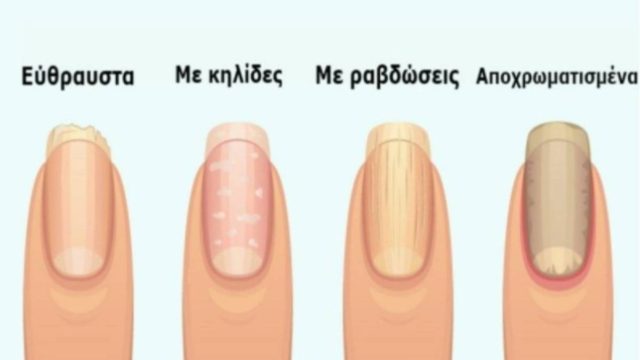 7+1 σημάδια στα νύχια που προειδοποιούν για σοβαρά προβλήματα υγείας