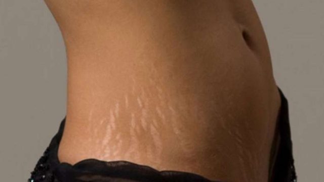 Εξαφανίστε τις ραγάδες με αυτή τη σπιτική κρέμα και 3 υλικά