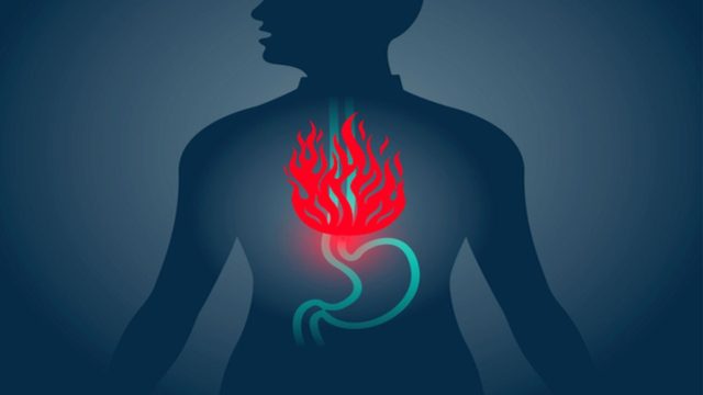 Δώσε τέλος στη καούρα με αυτό το κόλπο – Τέλος με τα φάρμακα του εμπορίου