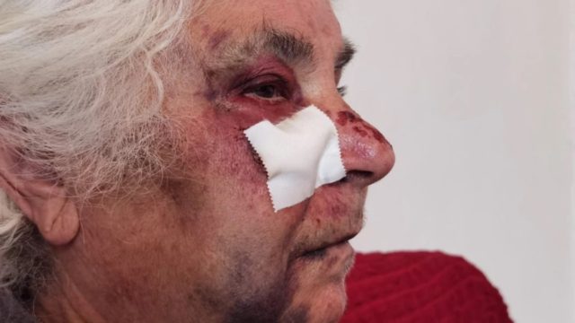 Εικόνες σοκ στο Αιγάλεω: Ληστές ξυλοκόπησαν άγρια 80χρονη – Της έσκισαν μέχρι και τα αυτιά για να της πάρουν τα σκουλαρίκια