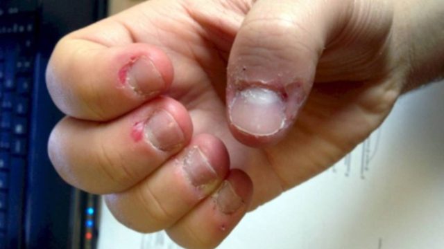 Αν πειράζετε το δέρμα γύρω από τα νύχια…σταματήστε το – Ο λόγος θα σας σοκάρει
