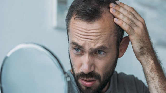 Αυτές είναι οι αιτίες που οι άνδρες χάνουν τα μαλλιά τους – Πότε θεωρείται μη φυσιολογικό