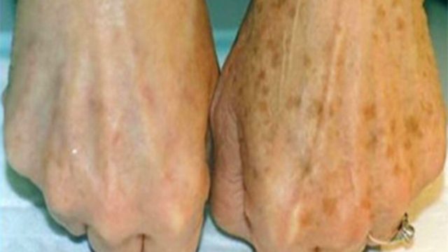 Ταλαιπωρείστε από πανάδες; Αυτό είναι το φυσικό υλικό που τις «εξαφανίζει»