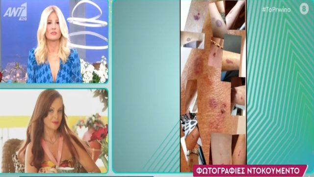 «Έκανα το εμβόλιο και δείτε τι έπαθα»: Η Χρυσηίδα Δημουλίδου δείχνει σε ζωντανή μετάδοση φωτογραφίες-ντοκουμέντο (Video)