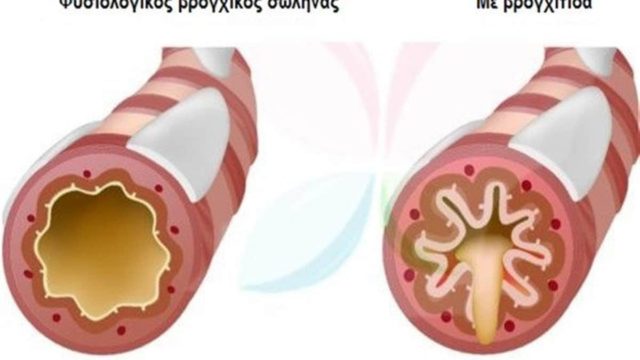 Κάνουν θαύματα: Αυτές είναι οι 10 τροφές που καταπολεμούν το άσθμα