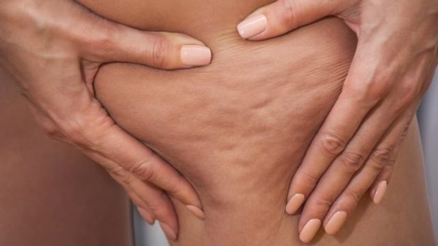 Έβαλε λεμόνι στο σώμα της και η κυτταρίτιδα μειώθηκε