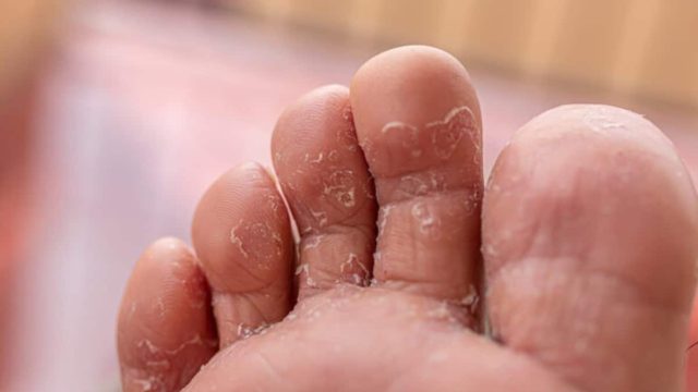 Έβγαλε μύκητες στα πόδια και δε σταματούσε να ξύνεται: Μόλις έβαλε μαγειρική σόδα…