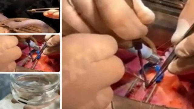 Πόλεμος στην Ουκρανία: Η στιγμή που γιατροί αφαιρούν σφαίρα από την καρδιά στρατιώτη και συνεχίζει να χτυπά (video)