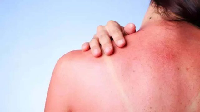 Το κόλπο με τη πατάτα για να μην ξεφλουδίσει το δερμα σας από τον ήλιο