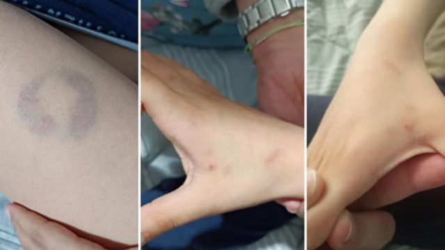 Άρτα: Διευθύντρια σχολείου δάγκωσε 11χρονο μαθητή ΑΜΕΑ – «Βρισκόμουν σε άμυνα»