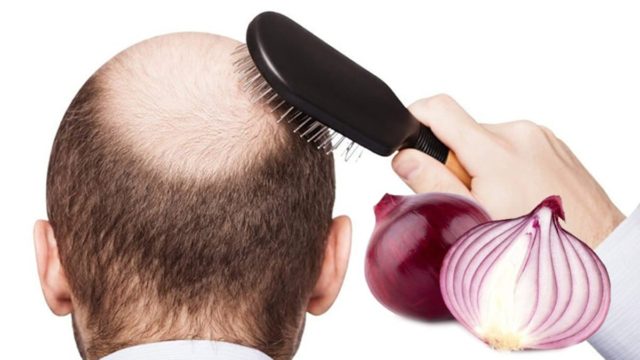Έφτιαξε μείγμα με κρεμμύδι και το έβαλε στα μαλλιά του για 15 λεπτά: Δεν πίστευε στο τέλος το αποτέλεσμα