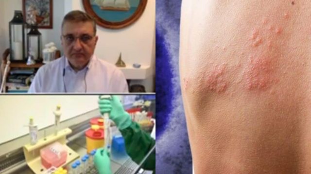 “Ανακούφιση” από Εξαδάκτυλο: «Η ευλογιά των πιθήκων δεν θα δημιουργήσει ποτέ το πρόβλημα του κορωνοϊού» (video)
