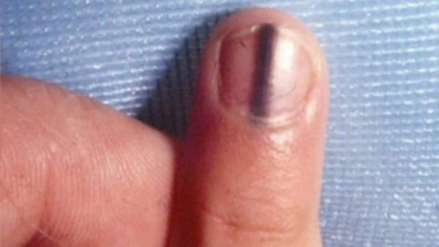 Παρατήρησε μια μαύρη γραμμή μέσα στο νύχι της – Τότε ο γιατρός της αποκάλυψε ότι… Απίστευτο! (Video)