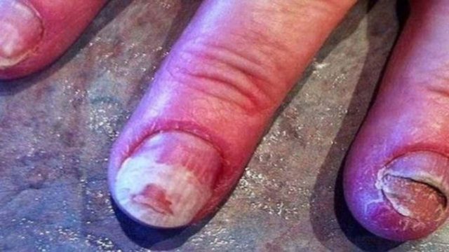 Κατέστρεψε τα νύχια της με ένα υλικό που όλες οι γυναίκες χρησιμοποιούν και είναι στο ημιμόνιμο!