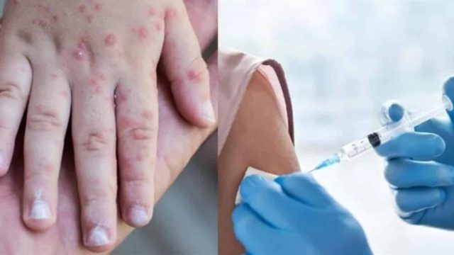 ΕΜΑ: «Πράσινο φως» στο εμβόλιο Imvanex για την ευλογιά των πιθήκων