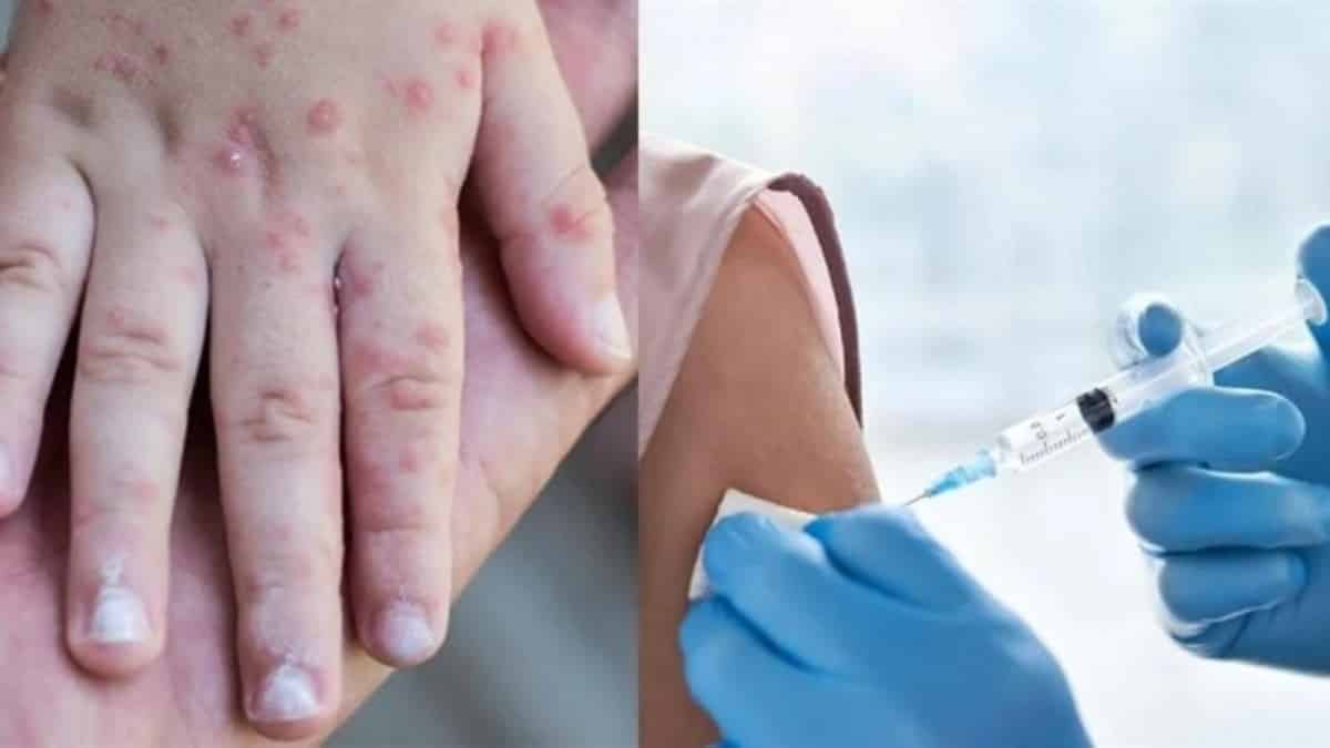 ΕΜΑ: «Πράσινο φως» στο εμβόλιο Imvanex για την ευλογιά των πιθήκων