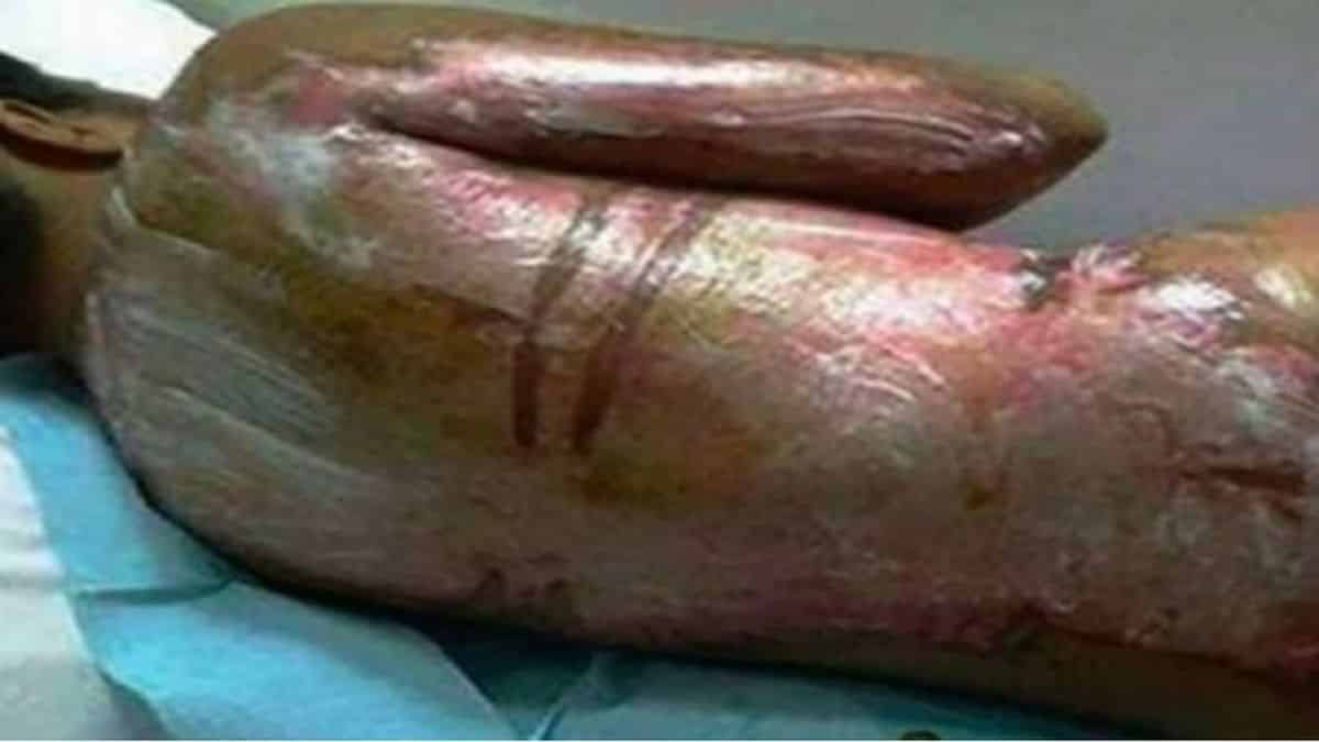 Μπήκε στο νοσοκομείο ουρλιάζοντας και έδειξε την πλάτη της – Αυτό που της το προκάλεσε θα σας σοκάρει!