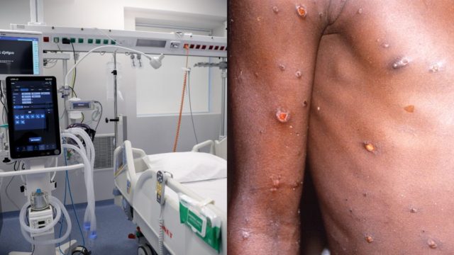 Νέα στοιχεία για την ευλογιά των πιθήκων: Μόνο άνδρες τα κρούσματα στην Ελλάδα – Πόσα περιστατικά έχουν καταγραφεί και ποια η κατάστασή τους (video)