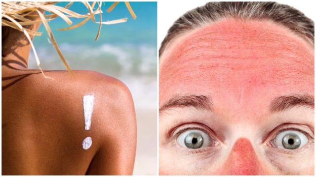 Κάηκες από τον ήλιο; 7+1 tips για να καταπραΰνεις την επιδερμίδα σου