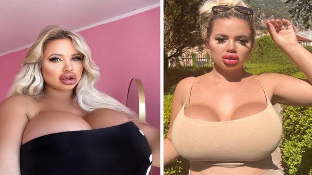 Έδωσε 57.000 ευρώ σε πλαστικές για να γίνει «Barbie» και τώρα δεν της μιλάει…