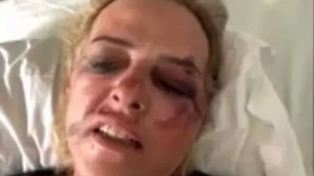 Καλαμάτα: Σοκάρει η γυναίκα που δέχθηκε επίθεση από αδέσποτα σκυλιά – «Προσπάθησα να τα αποφύγω…»