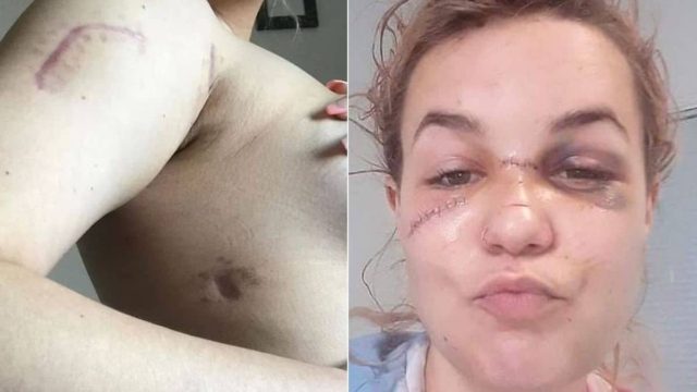 «Ζω από θαύμα – Με μαχαίρωσε 11 φορές επειδή ήθελα να τον χωρίσω»