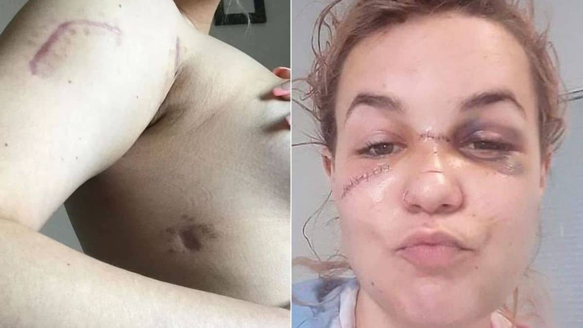 «Ζω από θαύμα – Με μαχαίρωσε 11 φορές επειδή ήθελα να τον χωρίσω»