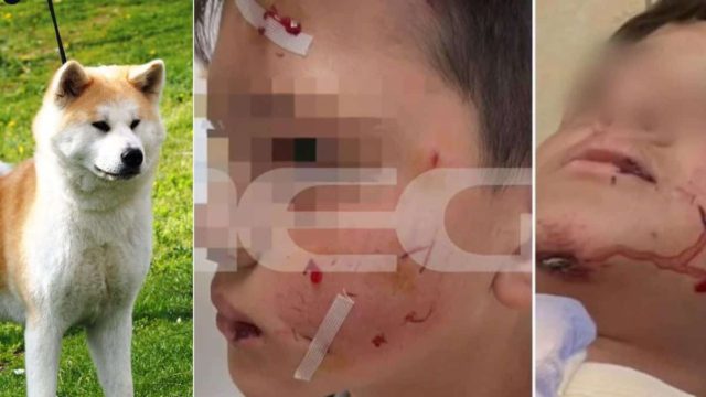 «O σκύλος θα τον είχε σκοτώσει»: Σοκάρει η μητέρα του 13χρονου μετά από επίθεση από σκυλί Ακίτα