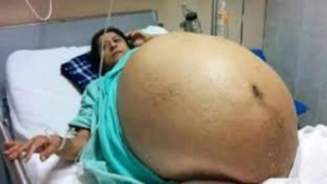 Έγκυος ή όχι; Η κοιλιά του μεγάλωνε μέρα με τη μέρα – Αυτό που βρήκαν μέσα είναι απλά απίστευτο!