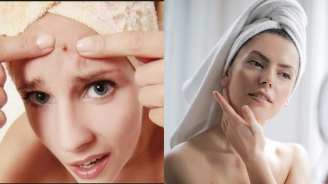 Απρόσμενο σπυράκι: Διώξτε τον ανεπιθύμητο “επισκέπτη” από το πρόσωπό σας με γιαούρτι και άλλα 2 υλικά