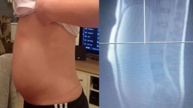 Νόμιζαν ότι αυτή η 17χρονη ήταν έγκυος – Όταν όμως οι γιατροί είδαν την αξονική της «πάγωσαν» (photo)