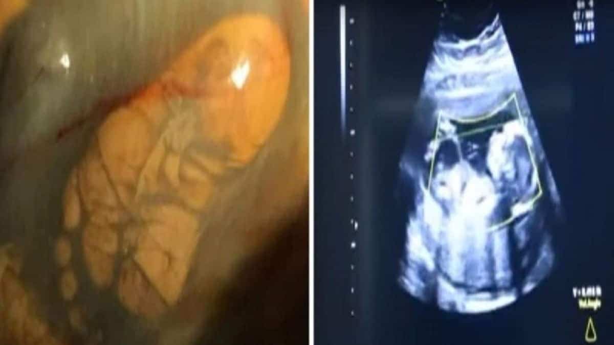 31χρονη ήταν 40 εβδομάδων έγκυος αλλά δεν πήγε ποτέ στον γιατρό για εξετάσεις – Αυτό που έδειξε ο πρώτος υπέρηχος… (Video)